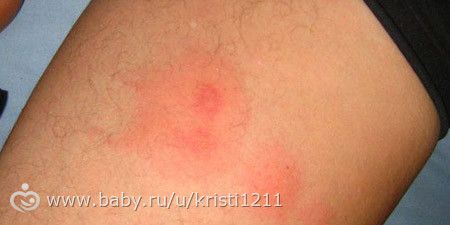 Как снять зуд от укуса пчелы в домашних условиях Как снять зуд от укуса пчелы в домашних условиях
