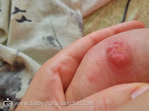 На сосках как будто прыщи На сосках как будто прыщи