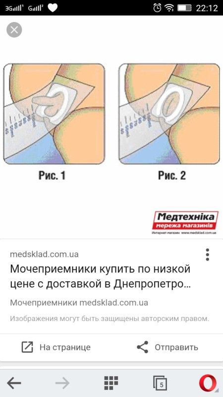 Как правильно наклеить мочеприемник девочке фото пошагово