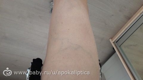 Стандарт по оказанию медицинской помощи при варикозном расширении вен
