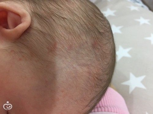 Аллергия? Потничка? Или гормональные? Аллергия? Потничка? Или гормональные?