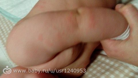 Аллергия ли?Кто сталкивался,помогите советом! Аллергия ли?Кто сталкивался,помогите советом!