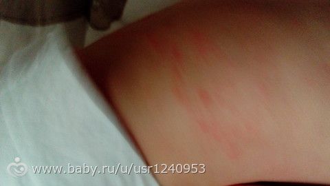 Аллергия ли?Кто сталкивался,помогите советом! Аллергия ли?Кто сталкивался,помогите советом!