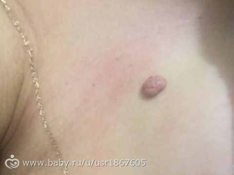 Мазь от папиллом на шее