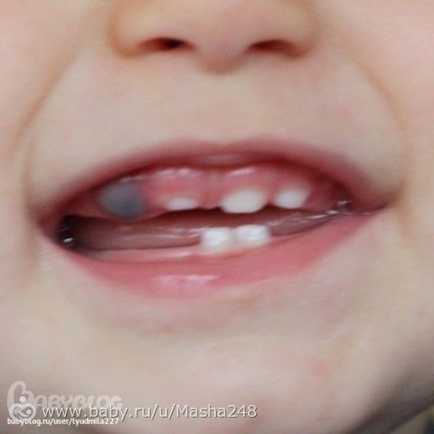 Синяк на десне при прорезывании зубов у ребенка фото Синяк на десне при прорезывании зубов у ребенка фото