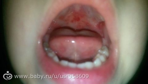 Красные точки на небе у ребенка: причины появления 94 Красные точки на небе у ребенка: причины появления 35
