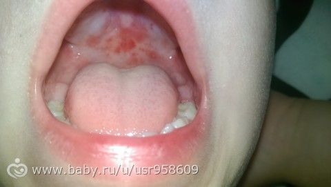 Красные точки на горле у ребенка что это такое 32 Красные точки на горле у ребенка что это такое 47