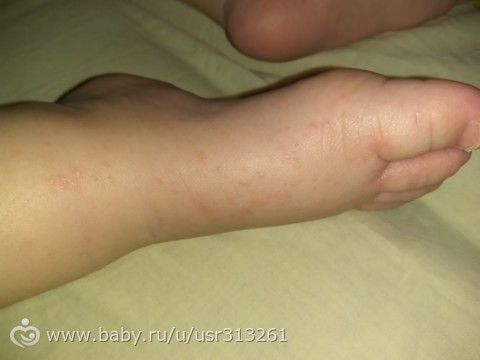 Аллергия на внешний слой подгузника??? Реально? Аллергия на внешний слой подгузника??? Реально?