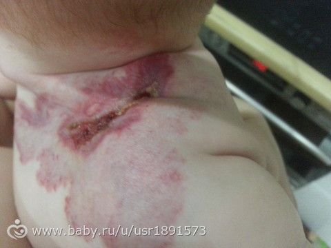 Она зажила!!!! (Наша гемангиома)