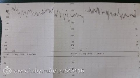 Ктг в 33 недели