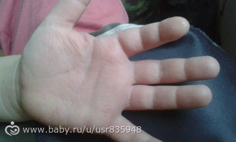 Что с руками у ребёнка?