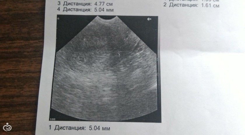 Первое УЗИ!